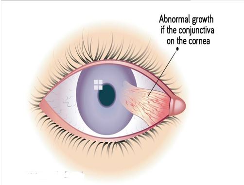 Modern medical illustration of a pterygium: a triangular, wing-shaped conjunctival growth advancing from the corner of the eye across the cornea.