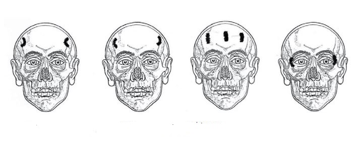 Schematic of the hypospathismos: four skull diagrams showing the positions of the forehead incisions used for chronic eye disease and migraine.