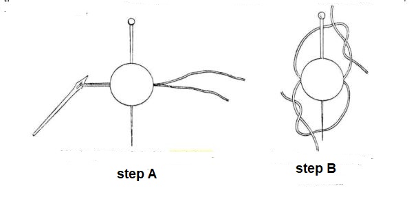 Two-step schematic of the ligation (apospinxis) of a staphyloma: step A drives a needle through the base, step B binds the thread off, after Paul of Aegina.