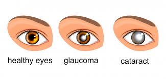 Illustration comparing a healthy eye with an eye affected by glaucoma and one affected by cataract.